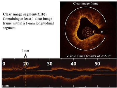 Feasibility and Safety of Very-Low Contrast Combined Ringer's Solution in Optical Coherence Tomography Imaging